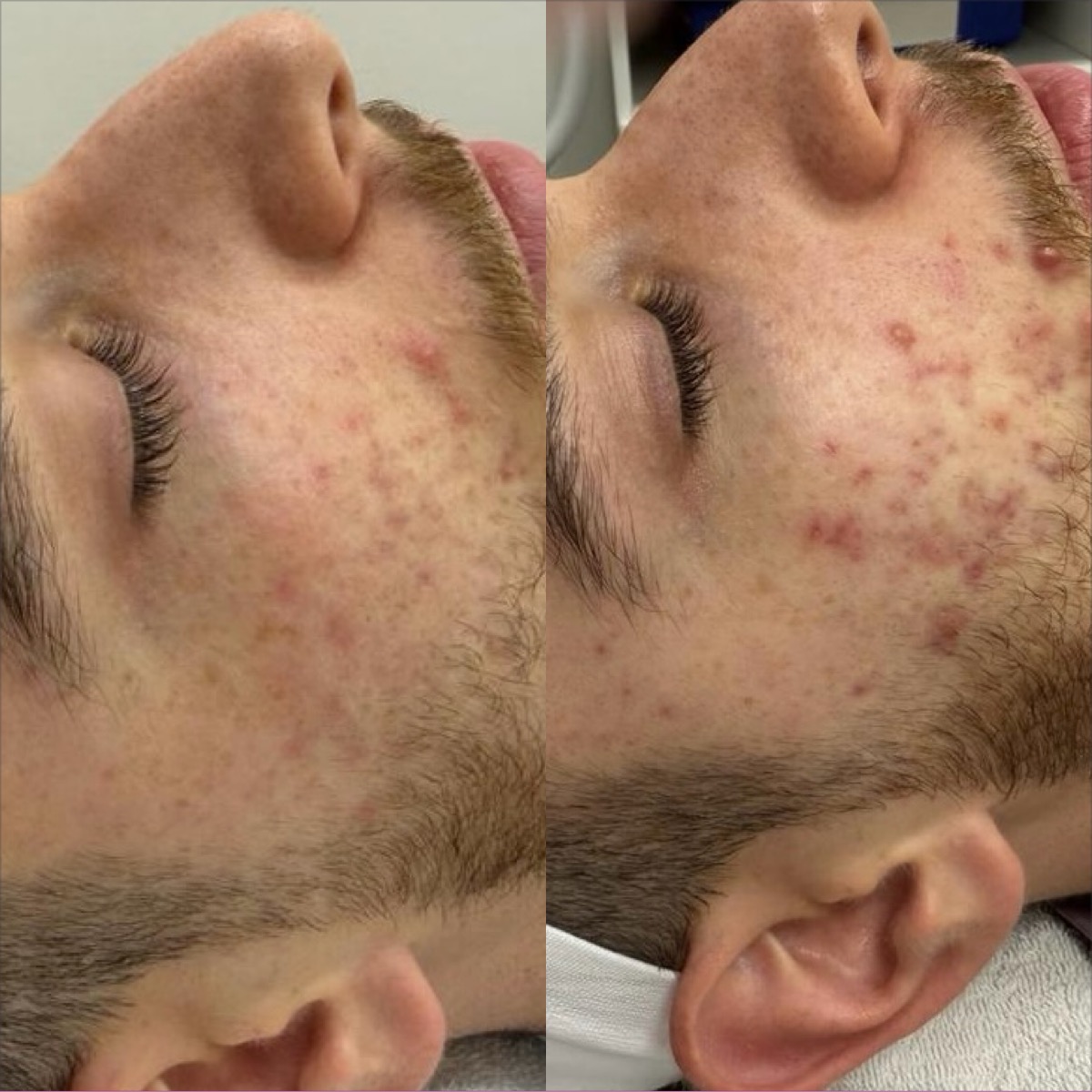 Acne treatment before and after results