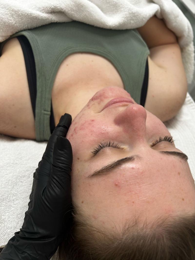 Professional acne extraction treatment